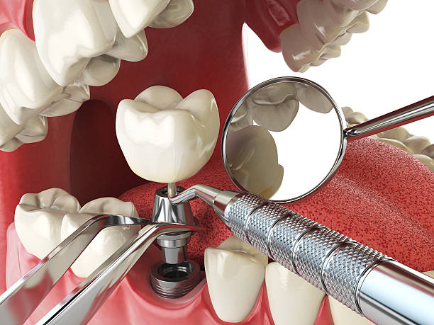 Best Emergency Denture Repair in Germantown Hls, IL
